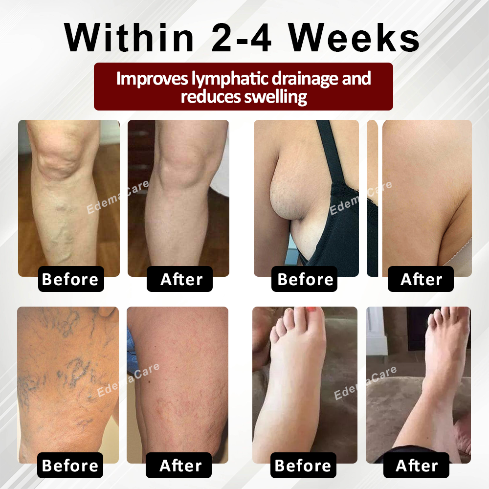 **Reclaim Your Freedom from Swelling Today!**
